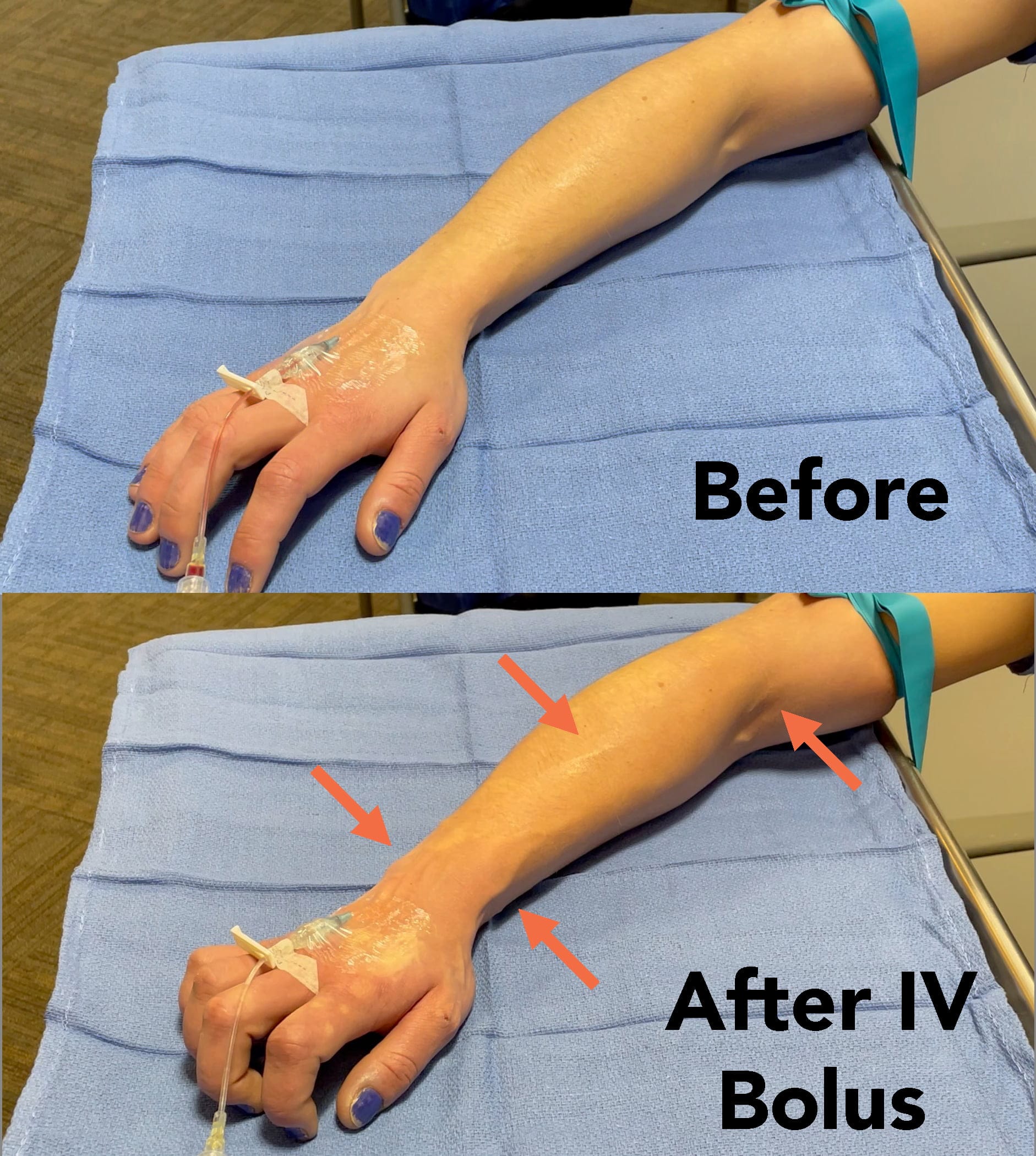 trick tourniquet infusion technique dilate upsizing vein arm peripheral IV