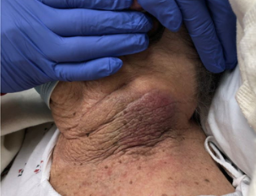 Diagnosis on Sight: Neck Bruising Leads to a Surprise Diagnosis