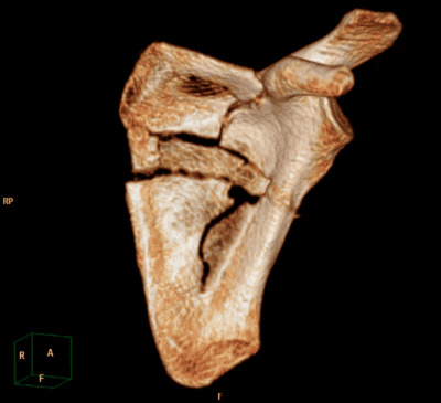 Shoulder CT