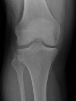 Segond Fracture