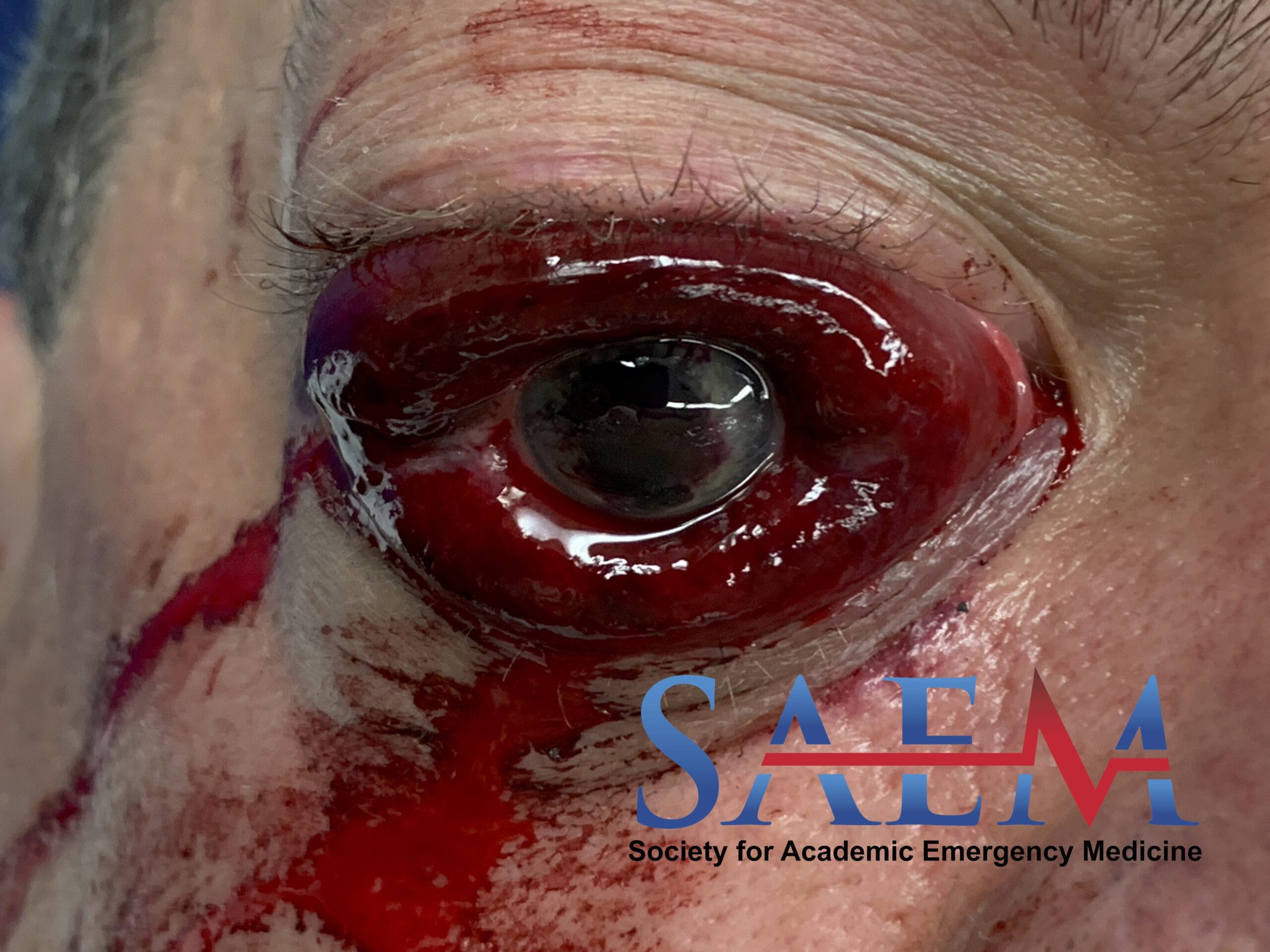 orbital compartment syndrome