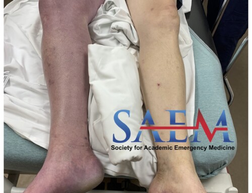 SAEM Clinical Image Series: Pulseless and Painful Blue Leg