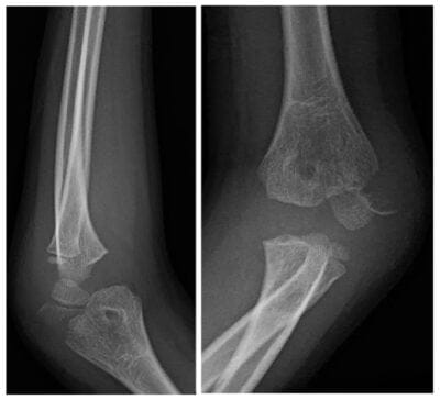 Elbow x-ray