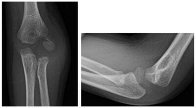 Elbow x-ray