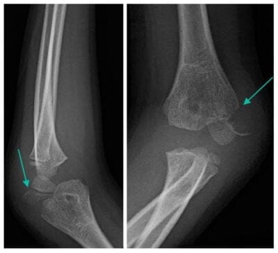 Elbow x-ray