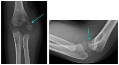 Elbow x-ray