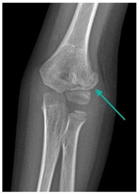 Elbow x-ray