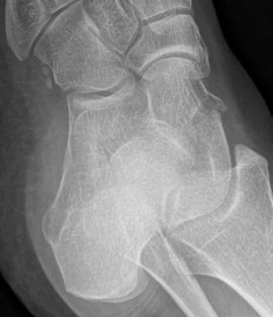 Talar Neck Fracture