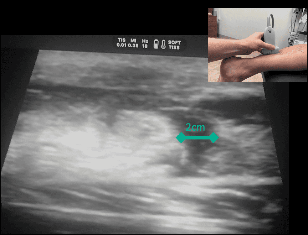 Achilles tendon rupture