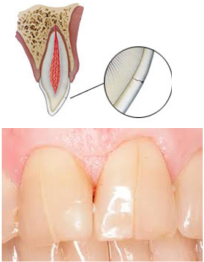 Uncomplicated Dental Fracture