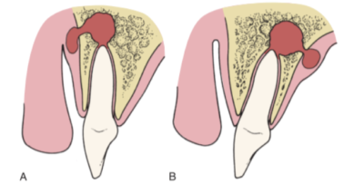 Diagram showing abscess formation around the roots of the maxillary incisors