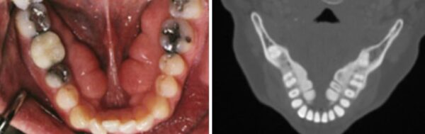 Maxillary Tori photo and a CT scan demonstrating the same