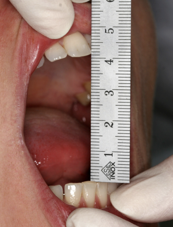 Measuring the maximal incisal opening with a ruler, between the incisal edges of upper and lower central incisors.