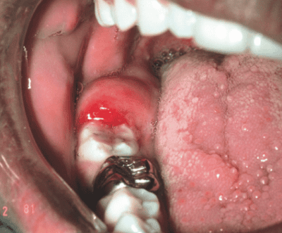 Example of pericoronitis