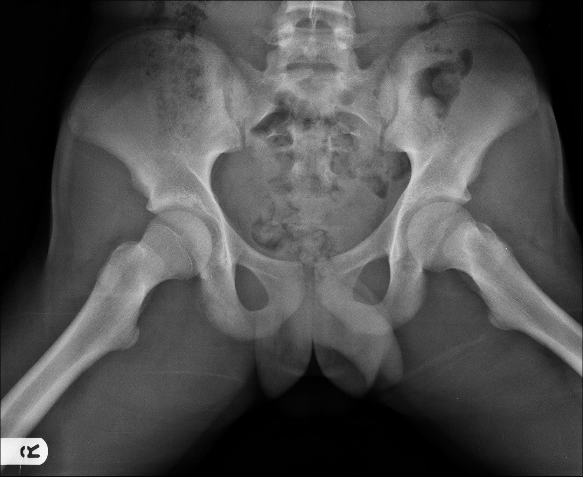 Frog leg lateral pelvis xray