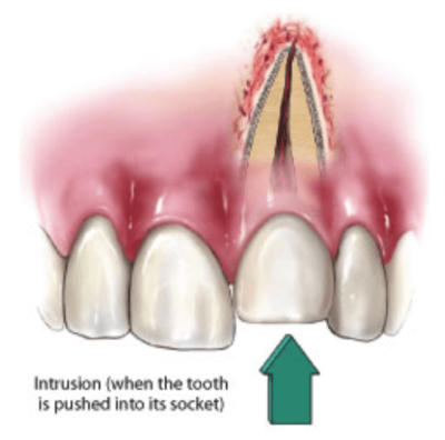 Diagram of Tooth Intrusion (when the tooth is pushed into its socket)