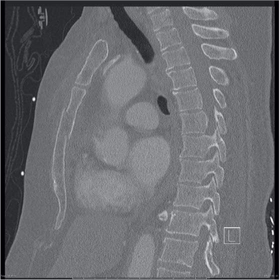 Sternal injury