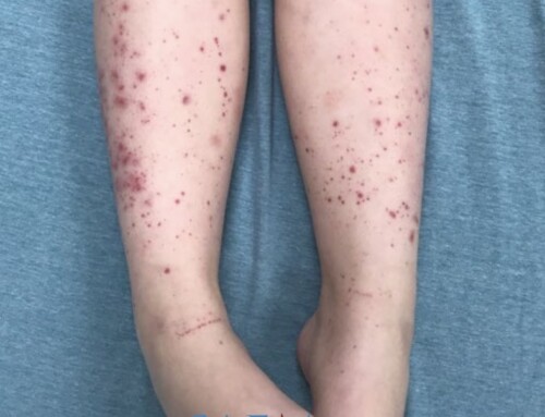 SAEM Clinical Image Series: Pediatric Rash