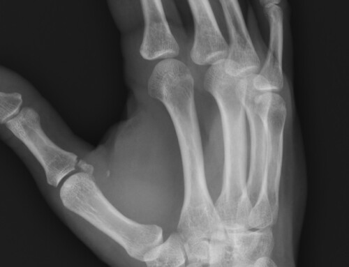 SplintER Series: I Declare a Thumb War