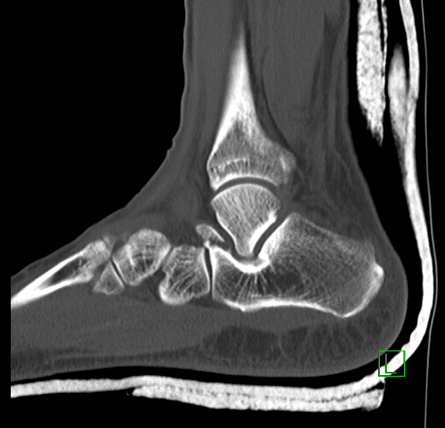 Subtalar dislocation