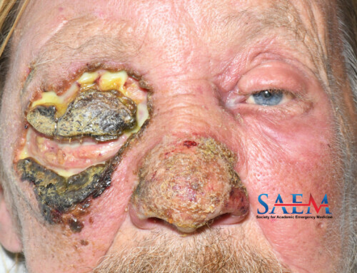 SAEM Clinical Image Series: Eye Pain