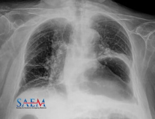 SAEM Clinical Image Series: An Uncommon Cause of Shortness of Breath