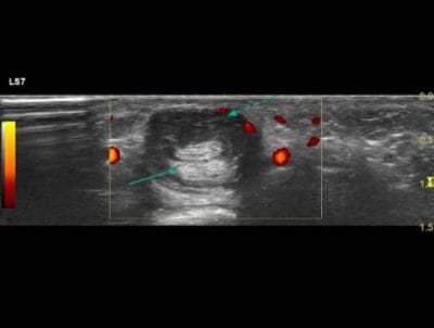 Ultrasound of flexor tendon indicating fluid around the sheath