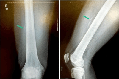 AP and lateral x-rays of the knee showing myositis ossificans