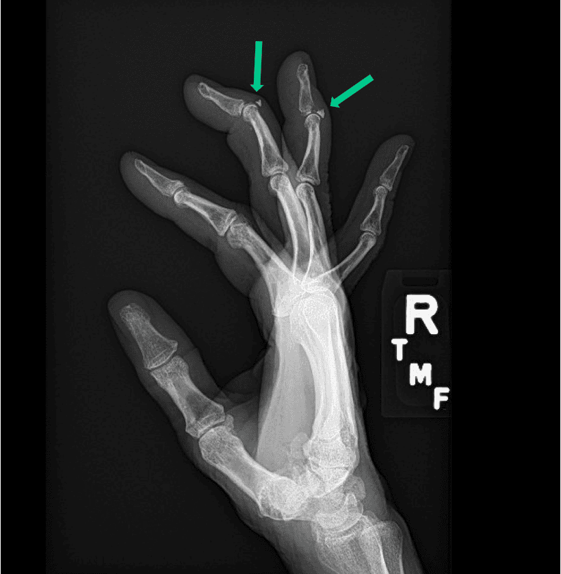 mallet finger