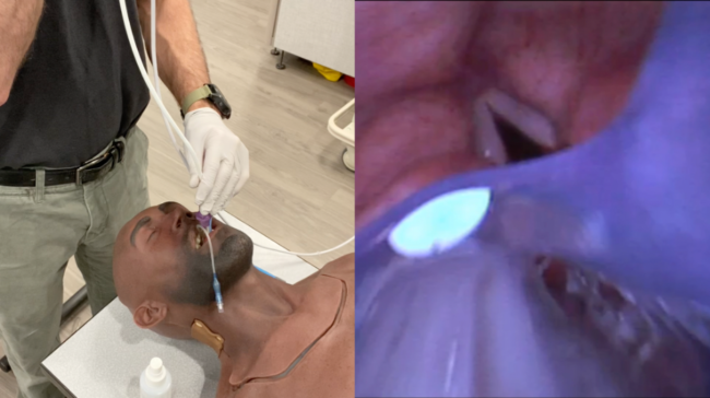 fiberbougie through supraglottic device king airway