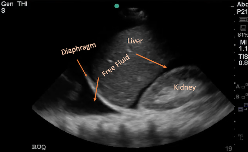 RUQ free fluid ultrasound