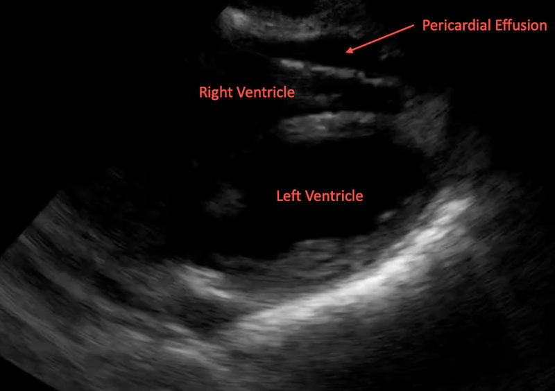abnormal pericardial FF ultrasound