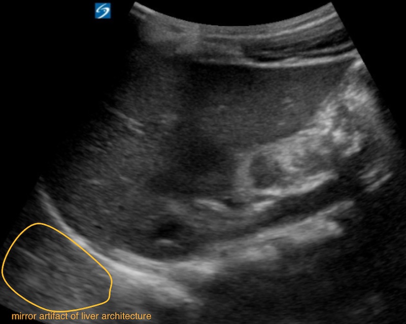 ultrasound spine sign artifact