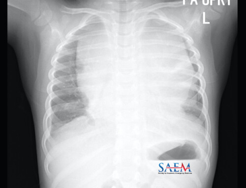 SAEM Clinical Images Series: ‘Tis Not the Season to be Wheezing