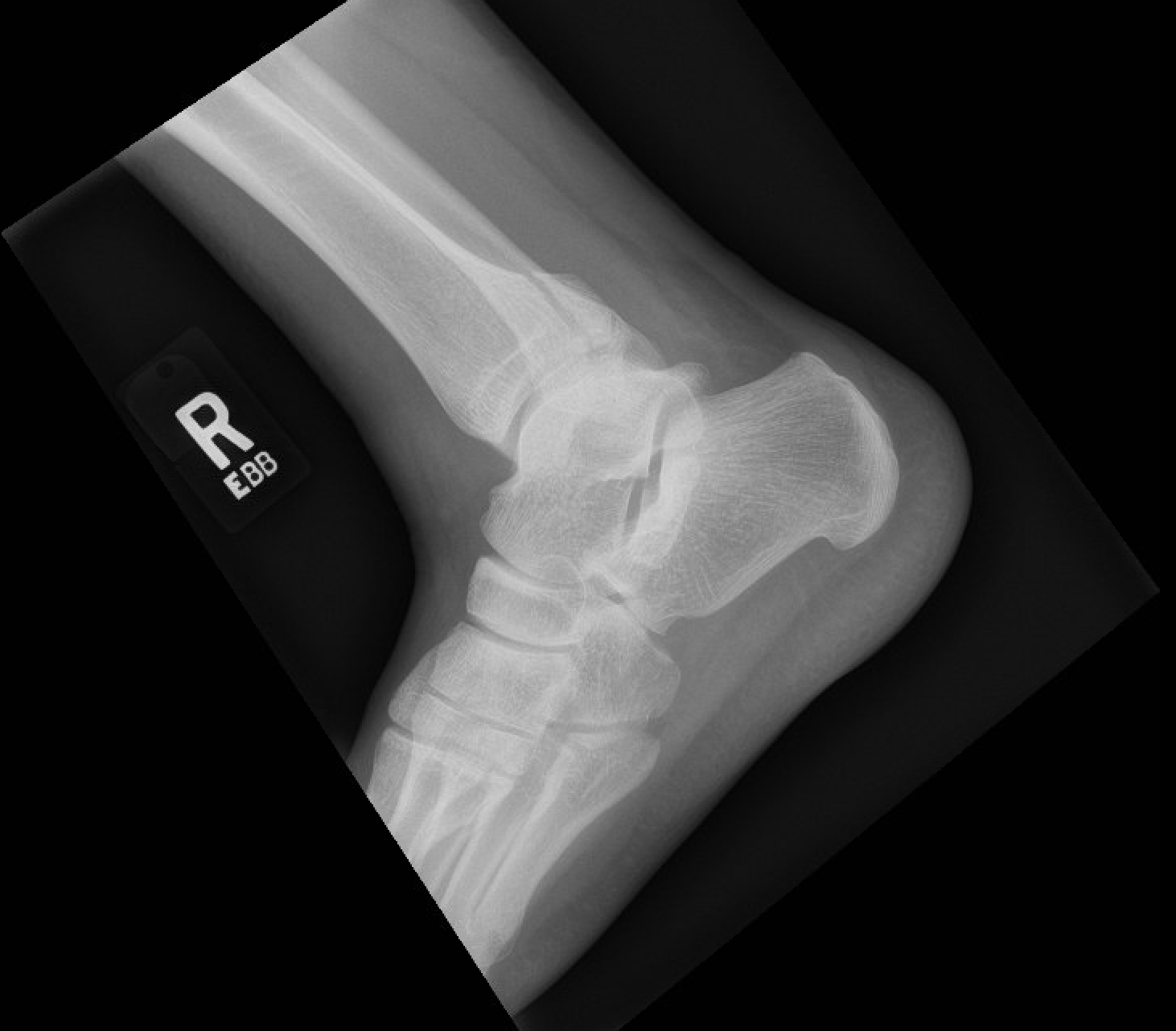 posterior malleolar fracture