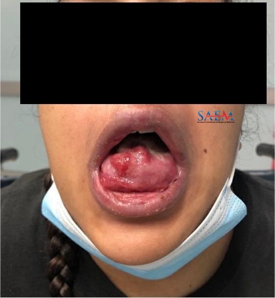 rash