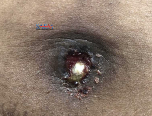 SAEM Clinical Images Series: An Ominous Umbilical Lesion