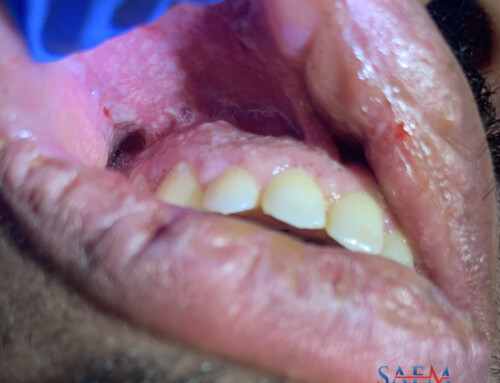 SAEM Clinical Images Series: Spicy Gum Leads to Spicy Gums