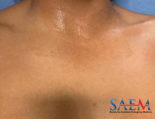 SAEM Clinical Images Series: My Shoulder Hurts
