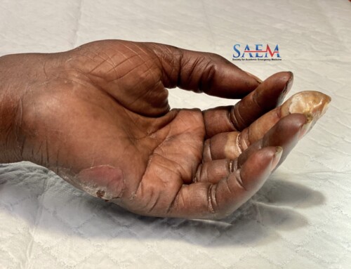 SAEM Clinical Images Series: A Painful Swollen Digit