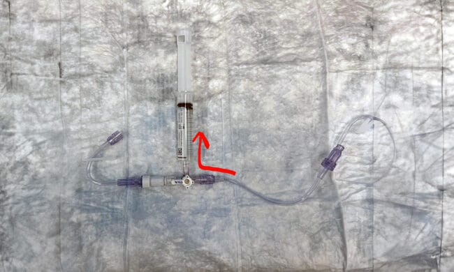 Trick of the trade stopcock pressure infusion IV fluids syringe start