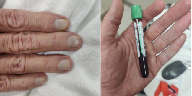 ACMT methemoglobinemia hand blue