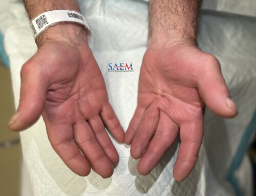 SAEM Clinical Images Series: Insidiously Contracted Hand