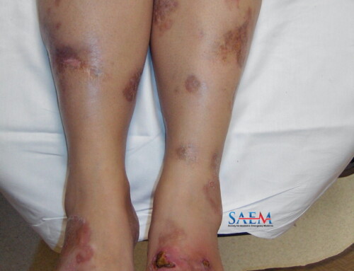 SAEM Clinical Images Series: A Case of Painful Skin Lesions