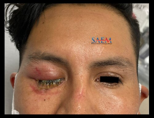 SAEM Clinical Images Series: Dangerous Eye Drainage