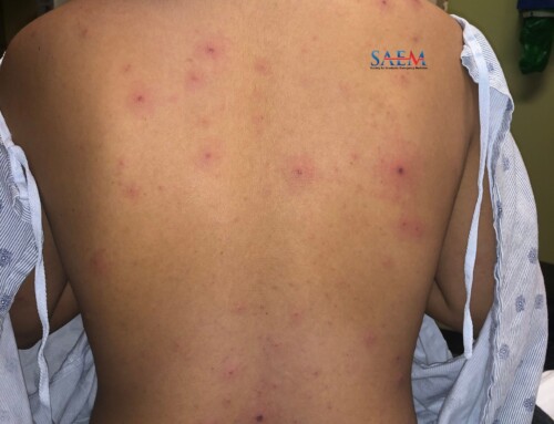 SAEM Clinical Images Series: Face and Chest Rash