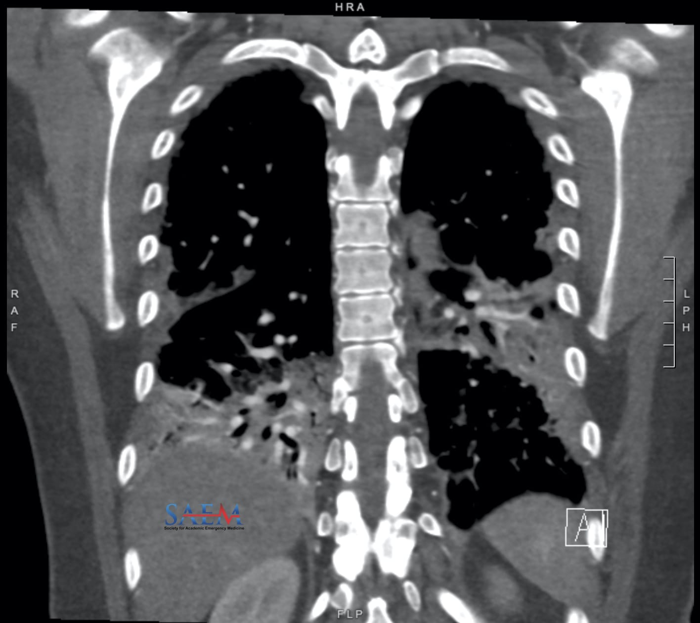 dermatomyositis