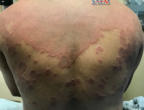 SAEM Clinical Images Series: Post-Vaccination Rash