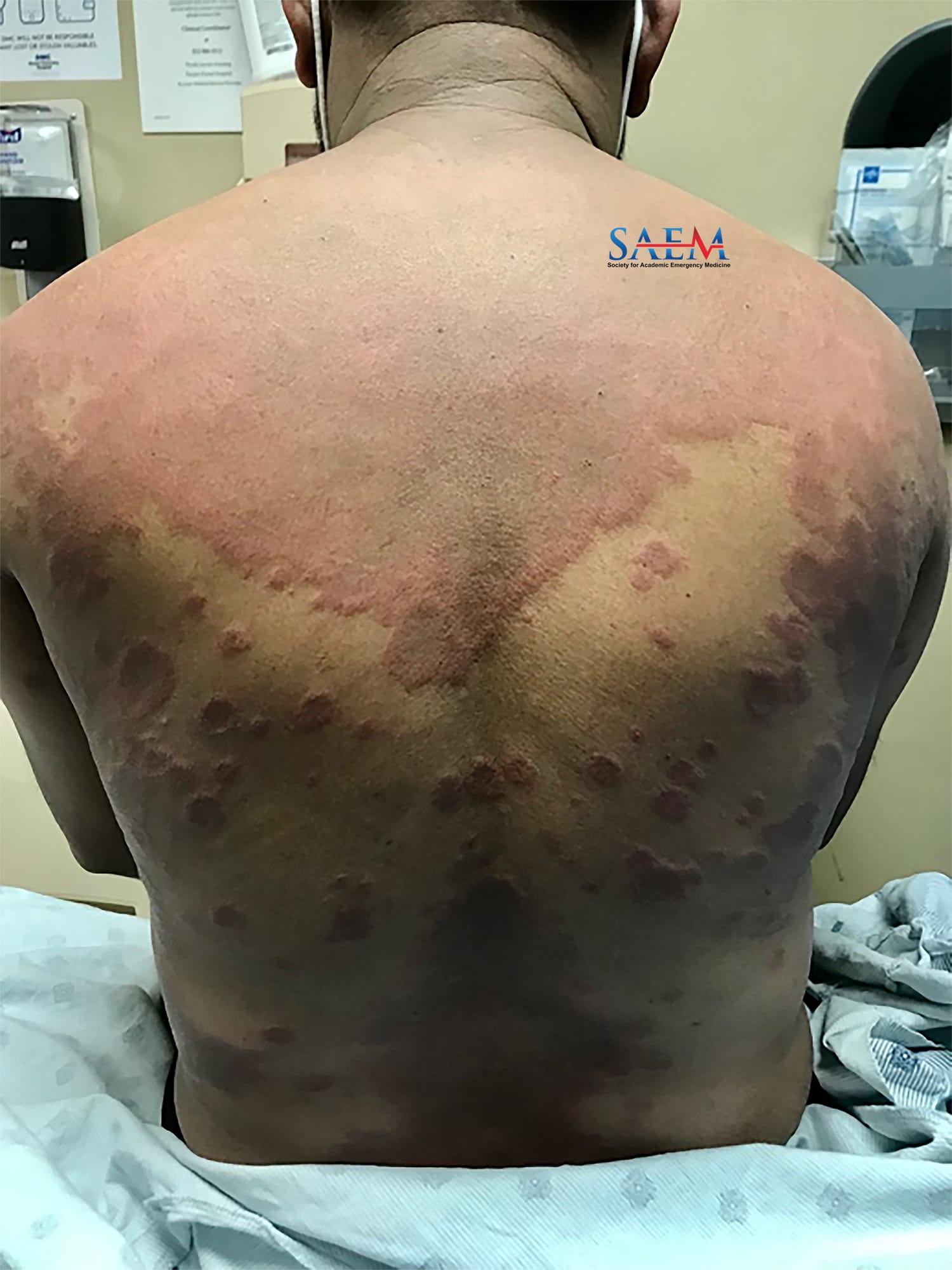 hypersensitivity