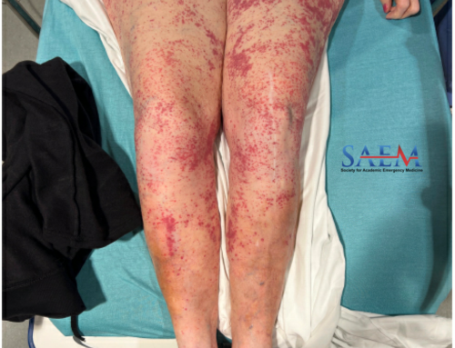 SAEM Clinical Images Series: A Rare Case of Purpura